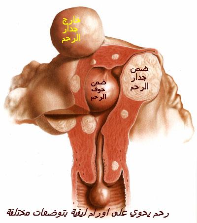 علاج الورم الليفي في fibrom arab.jpg